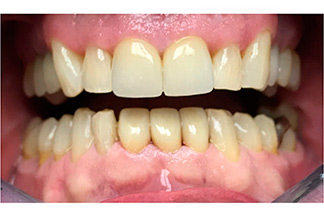 teeth after Ceramic Crown