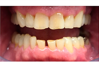 teeth before Ceramic Crown