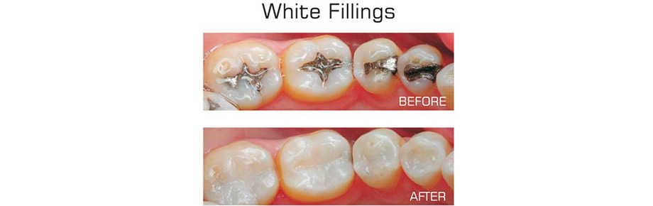 fillings
