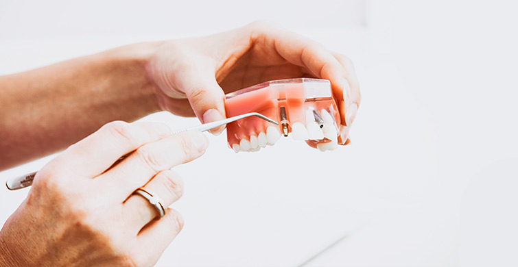 implants