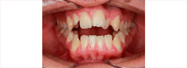 open bite